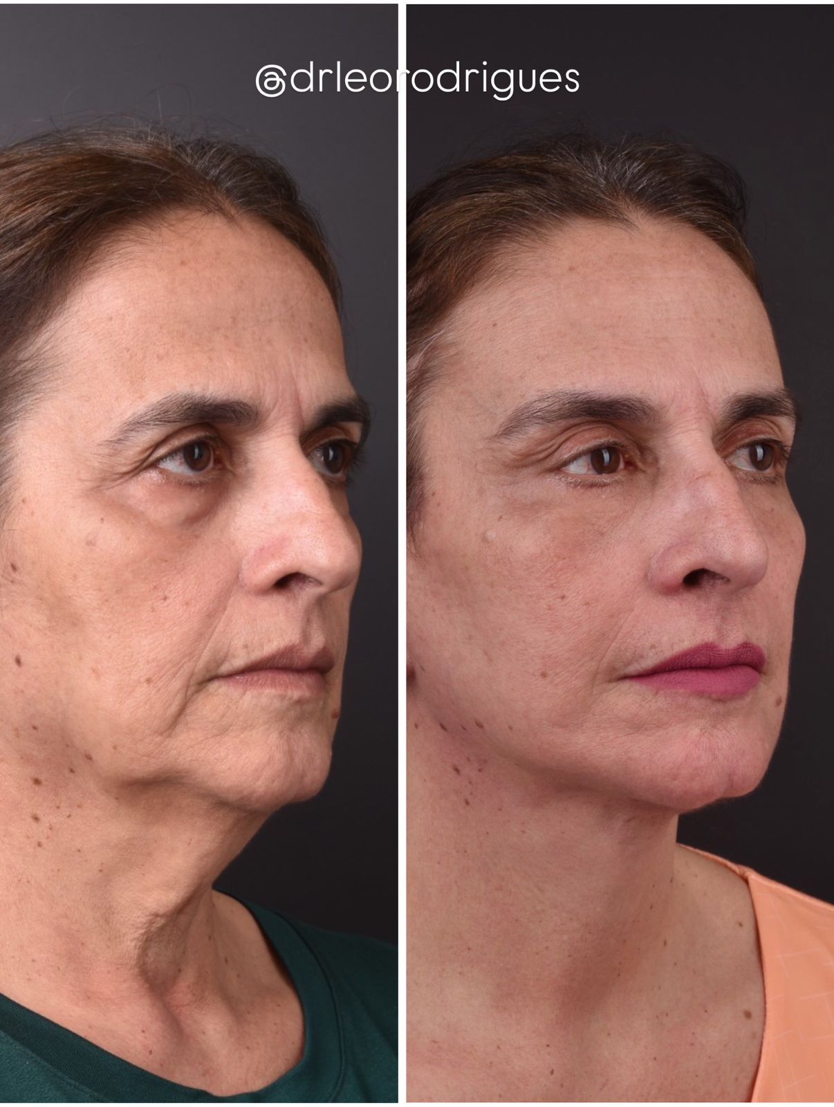 Depois do facelift: contorno redefinido, papada eliminada e expressão rejuvenescida