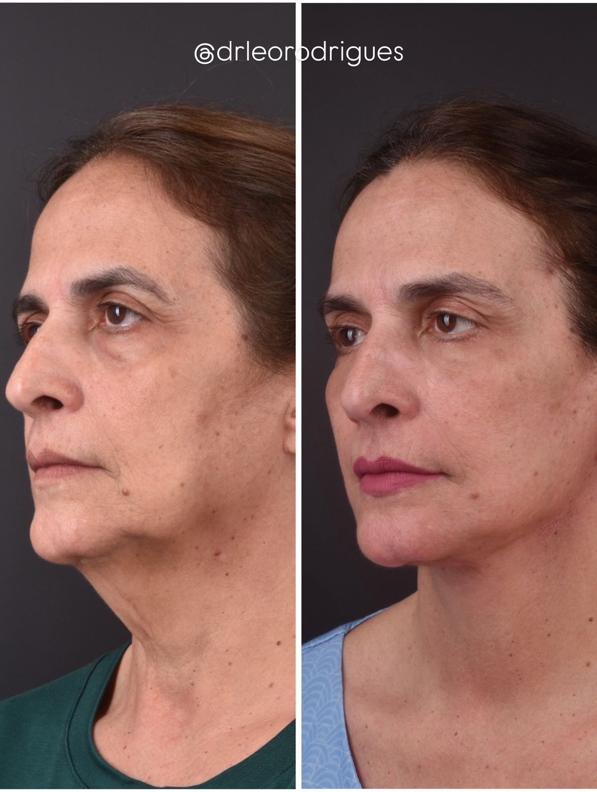 Antes do facelift: rosto com papada acentuada e contorno facial comprometido