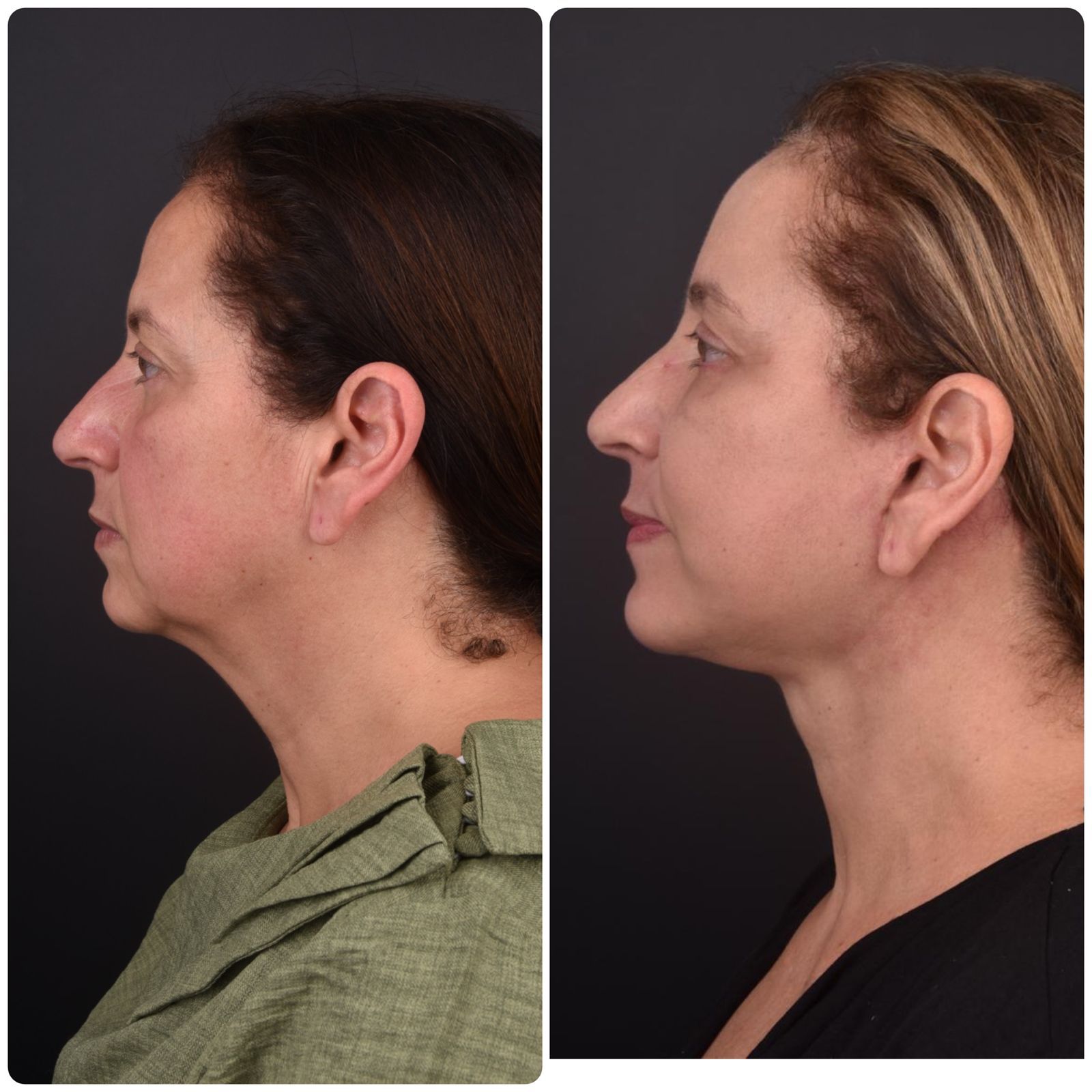 Depois do facelift: contorno firme, sulcos suavizados e expressão descansada